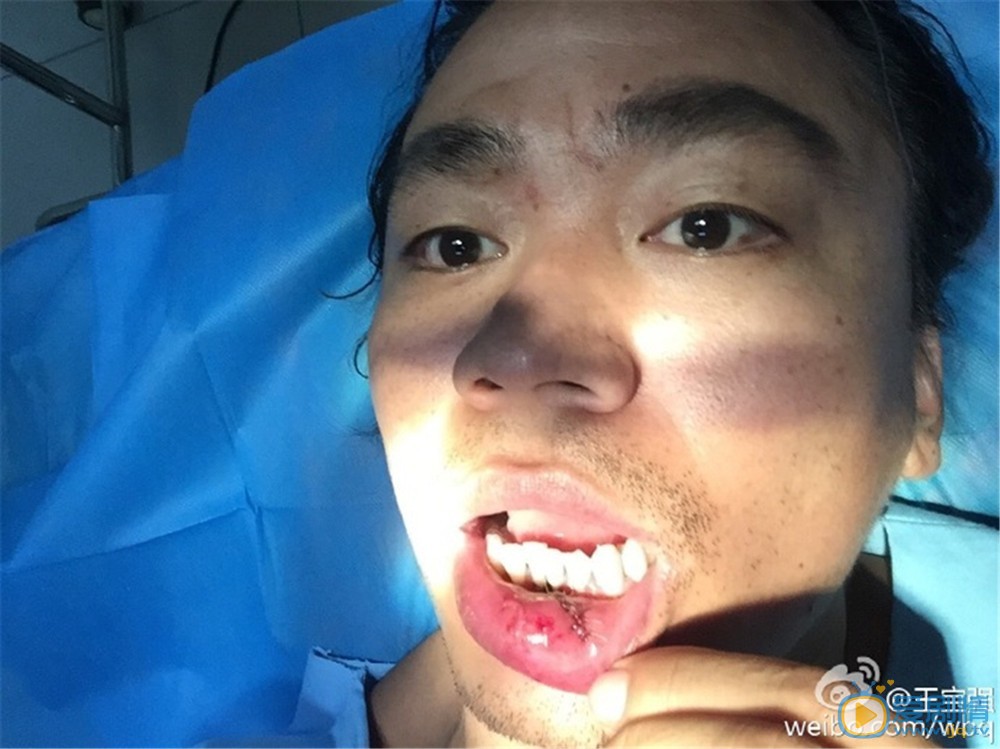 大鬧天竺王寶強意外負傷  嘴內縫十針仍堅持拍攝